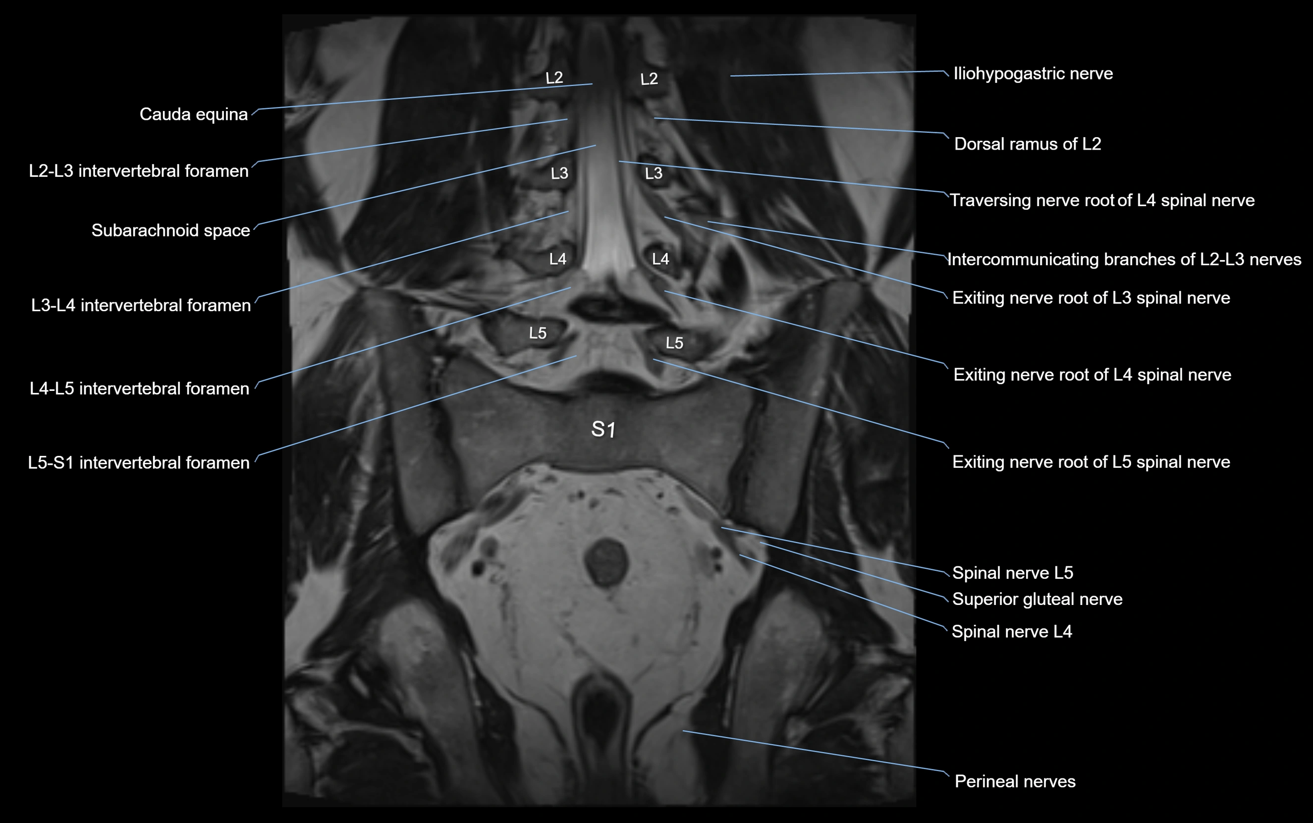 MR lumbosacral plexus cross sectional anatomy 3T  radiology  image-img-09001-00041.webp